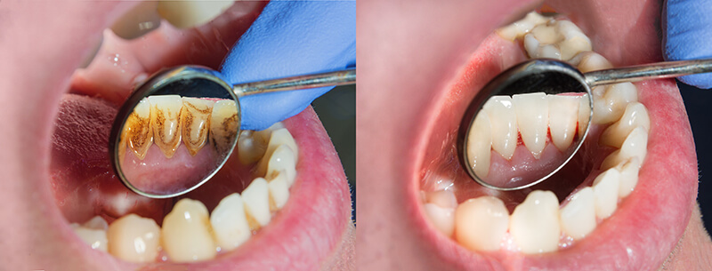 The Impact of Smoking on Your Teeth and Oral Health