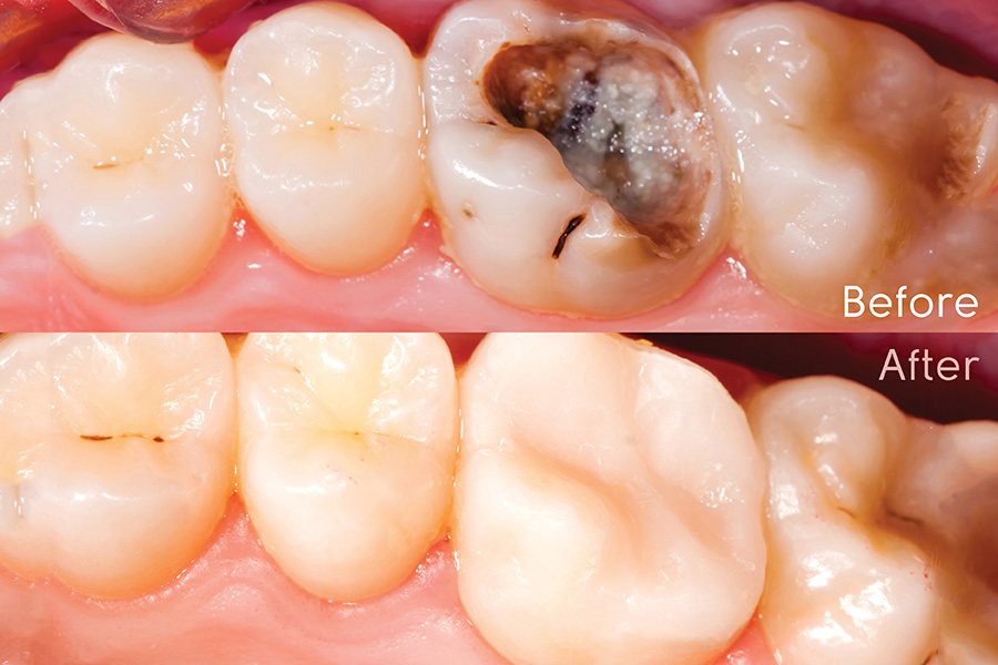 Composite Restoration