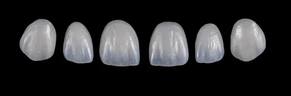 E-MAX VENEERS