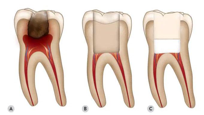 Pulpectomy: Saving Teeth and Relieving Pain in Pediatric Dentistry