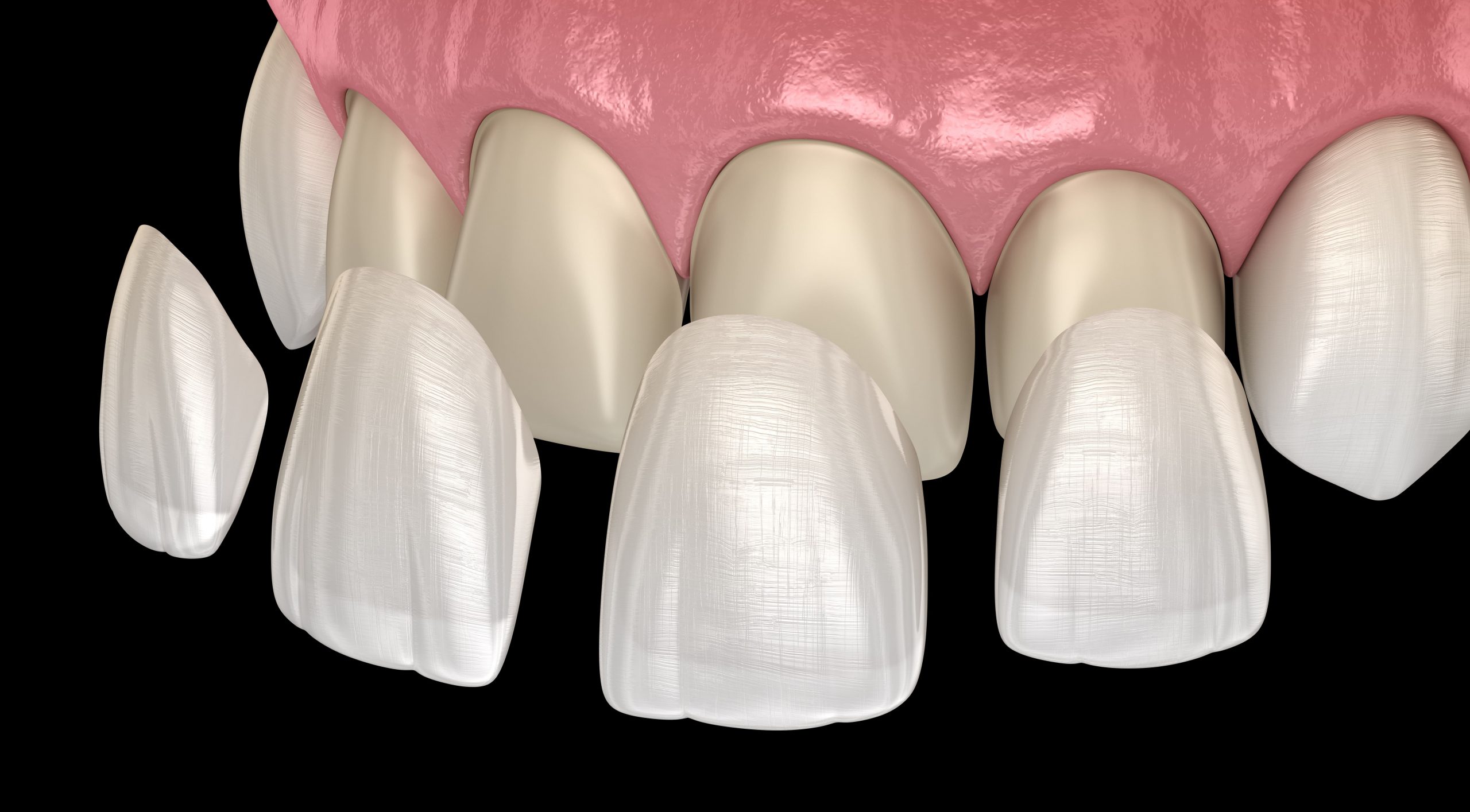 How Veneers Can Enhance Your Smile