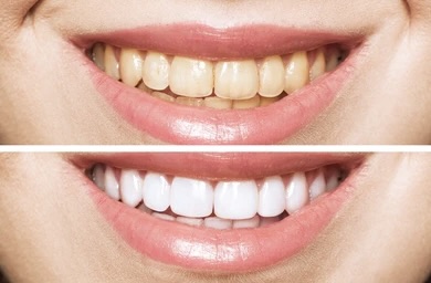 Teeth Whitening: Achieving a Brighter, More Radiant Smile