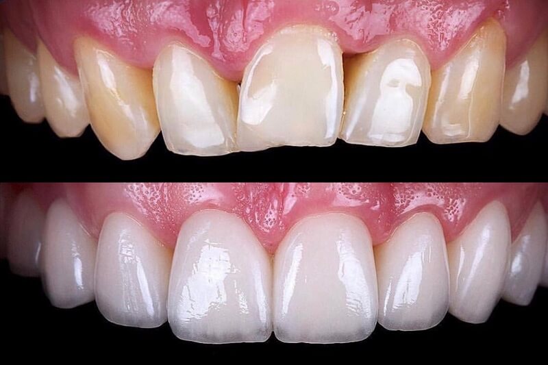 Veneers: Say Hello to Your Dream Smile
