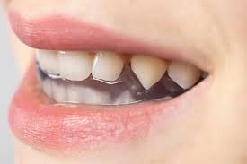 Custom Mouthguards for Grinding, Snoring, Sleep Apnea & Sports Protection