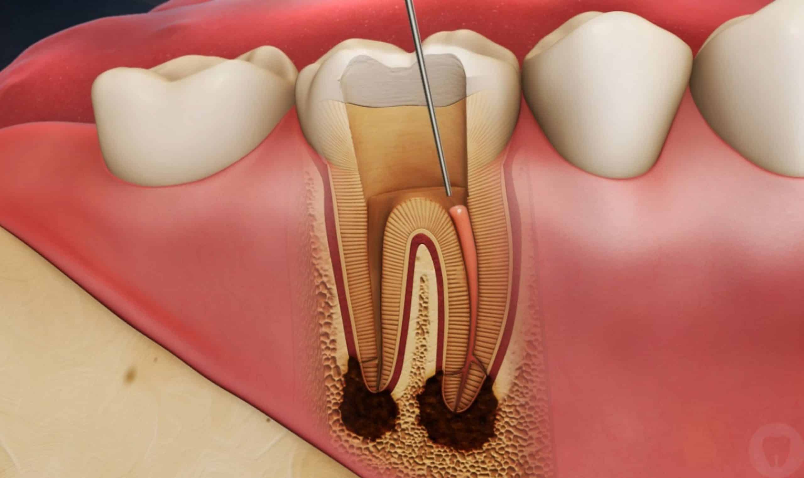 From Diagnosis to Relief: The Root Canal Experience