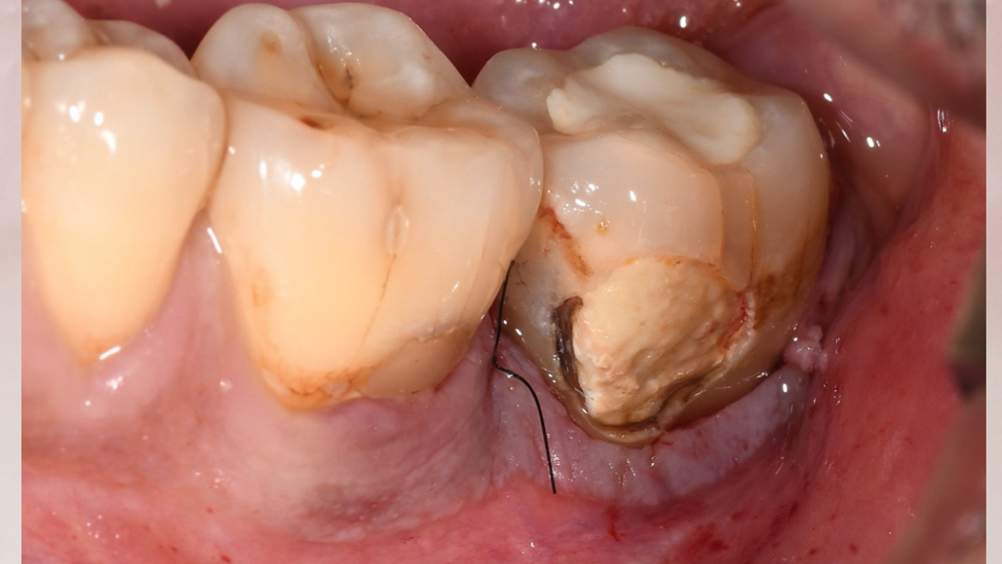 From Gingivitis to Healthy Gums: Your Periodontal Journey