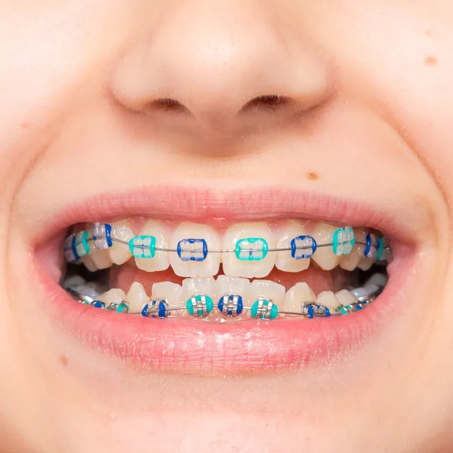 Orthodontics: Straight Teeth, Confident Smiles