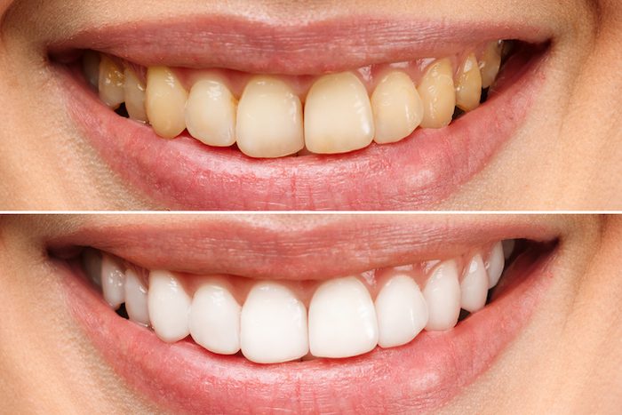 Smile Brighter: Tips and Treatments for Tooth Discoloration