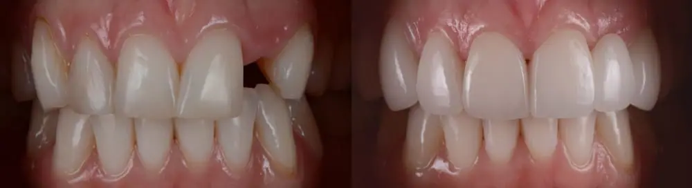 Replacing Missing Teeth with a Fixed Dental Bridge