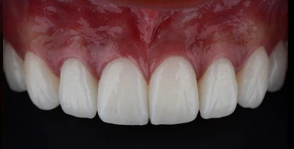 The Power of a Perfect Smile: Understanding Dental Veneers