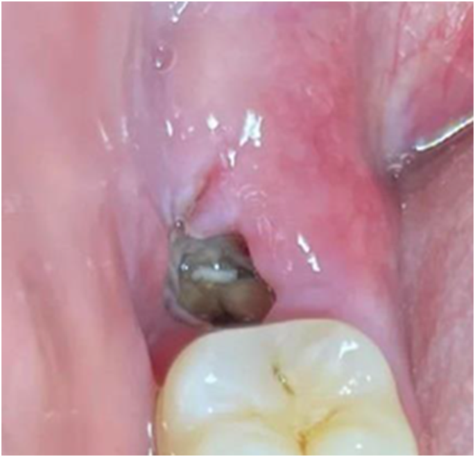 Understanding Dry Socket