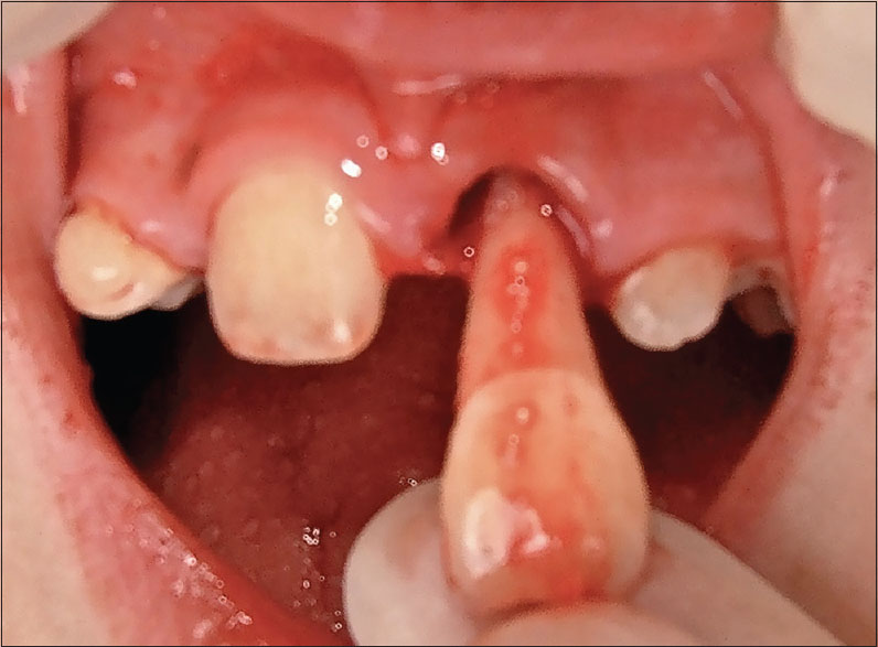 Tooth Avulsion: Managing a Knocked-Out Tooth