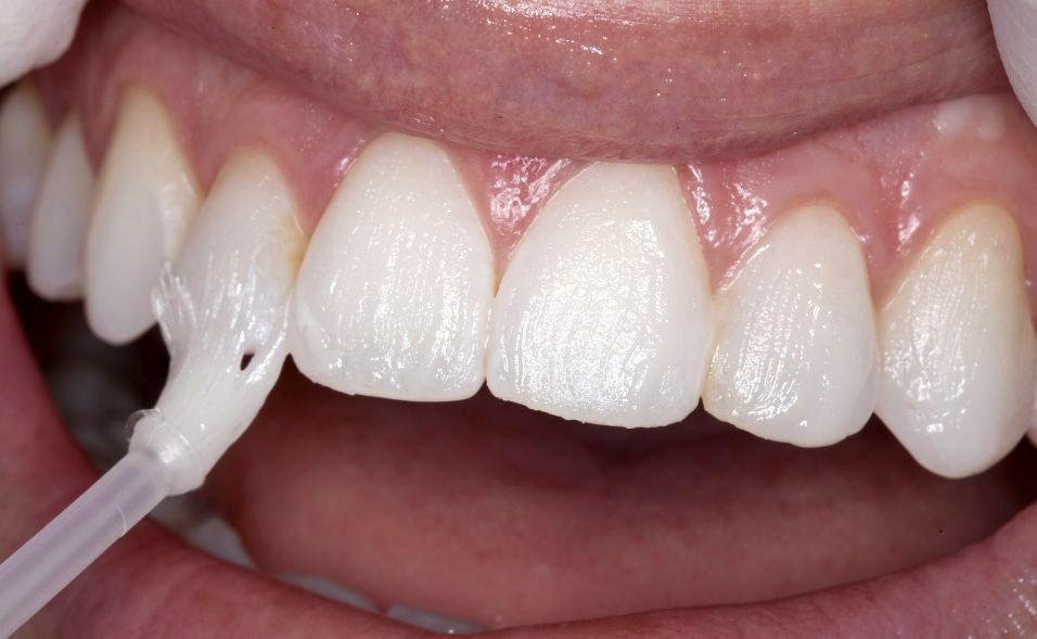 How Fluoride Helps Protect Teeth from Decay