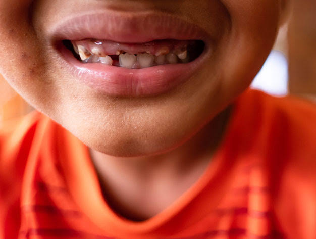 How to Prevent or Treat Baby Bottle Tooth Decay