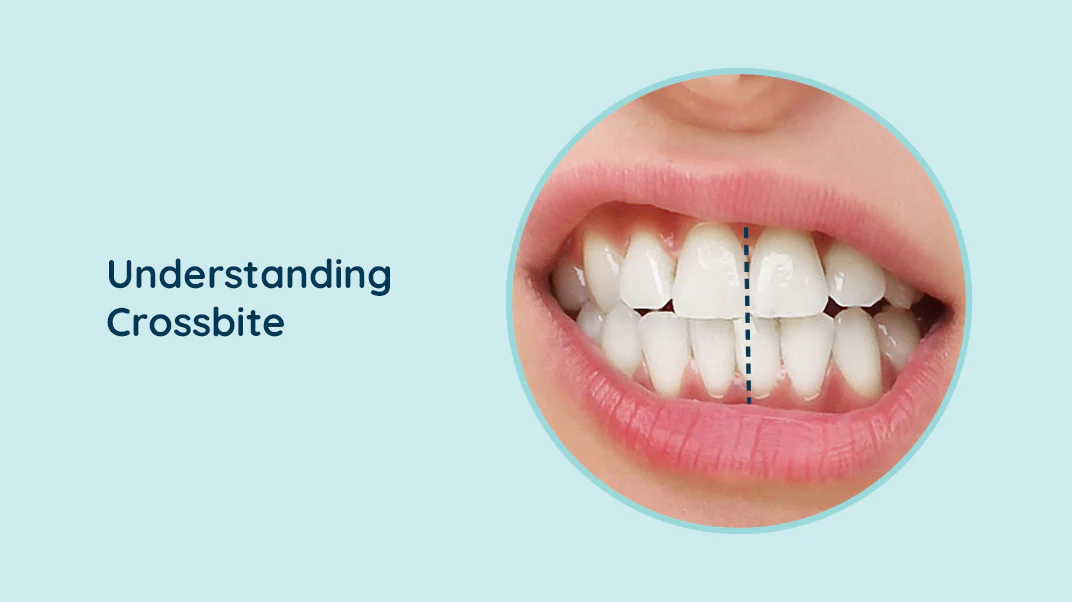 Crossbite Treatment Guide: From Causes to Corrective Options