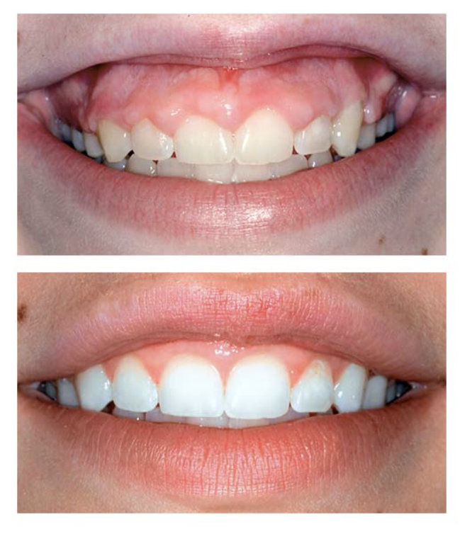 What Is a Gum Lift?
