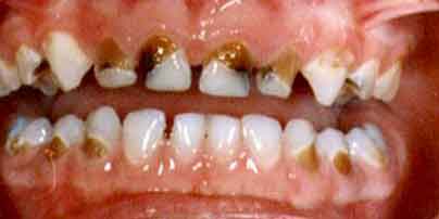 Baby Bottle Tooth Decay: Causes, Risks, and Prevention