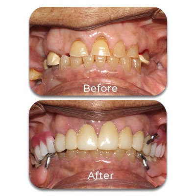 More about Zirconia Crowns