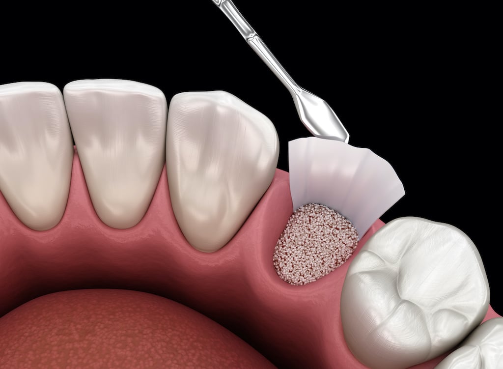 Bone Grafting in Dentistry