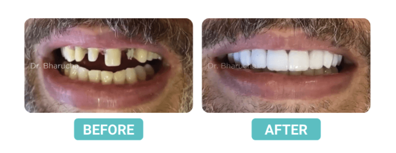 A Fixed Partial Denture