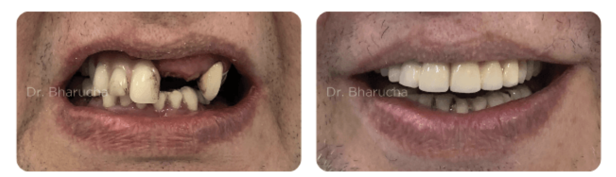 The Veneer Makeover: Restoring Function, Beauty, and Confidence
