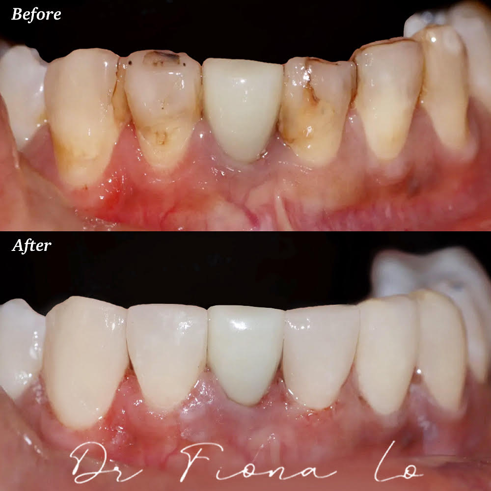 Veneers Smile Transformation 