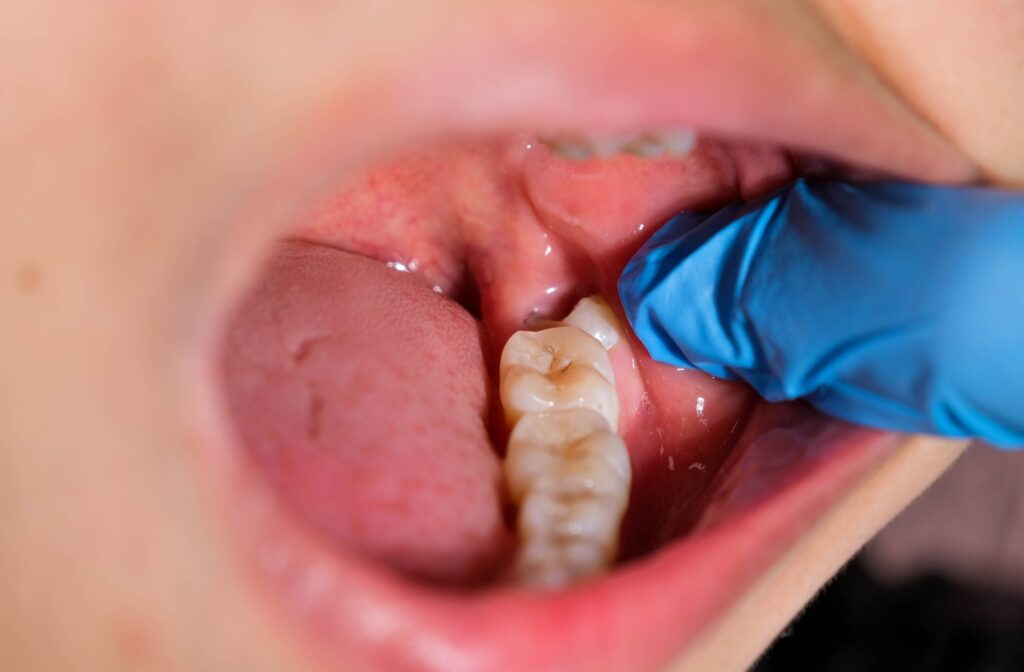 How Wisdom Tooth Removal Helps Your Oral Health