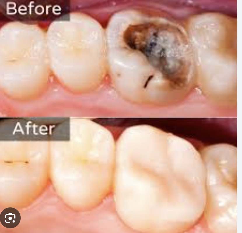 Damaged Teeth Be Restored.