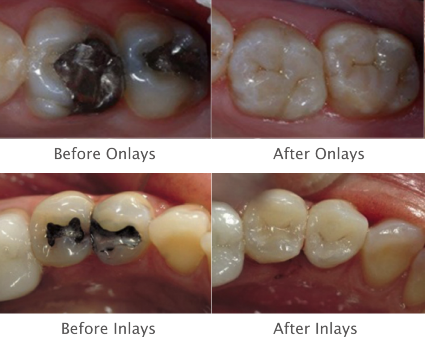 CERAMIC RESTORATIONS