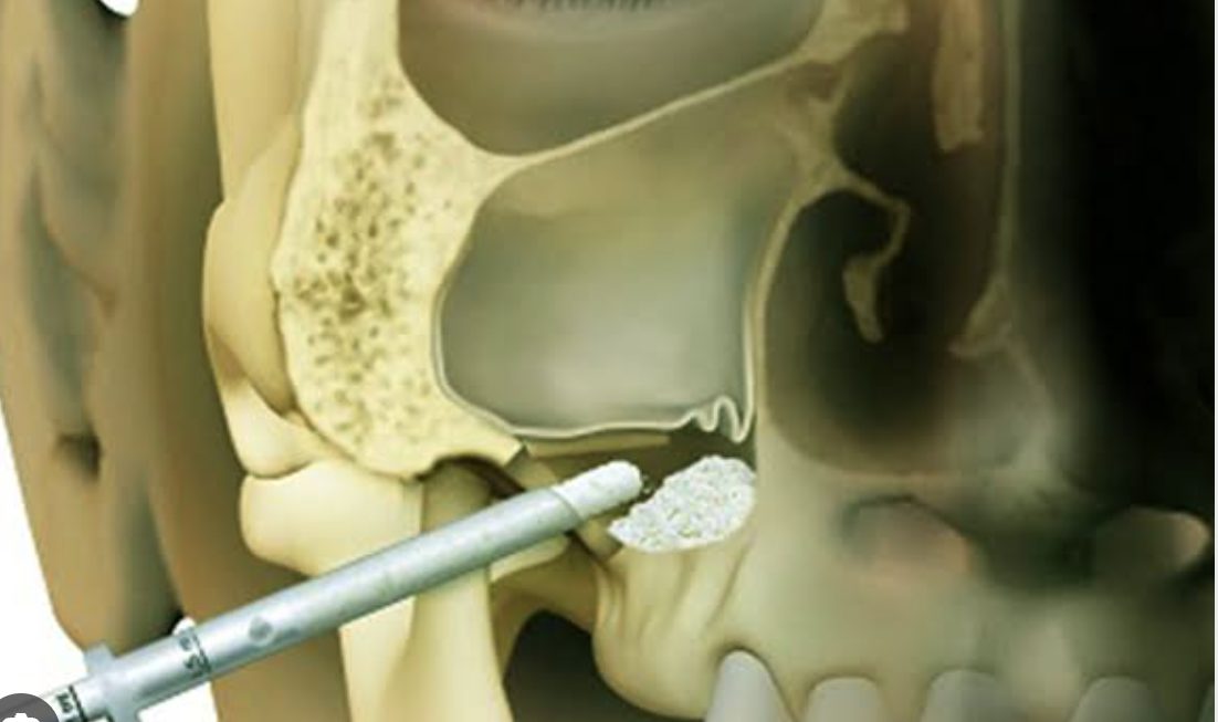 Sinus Lift