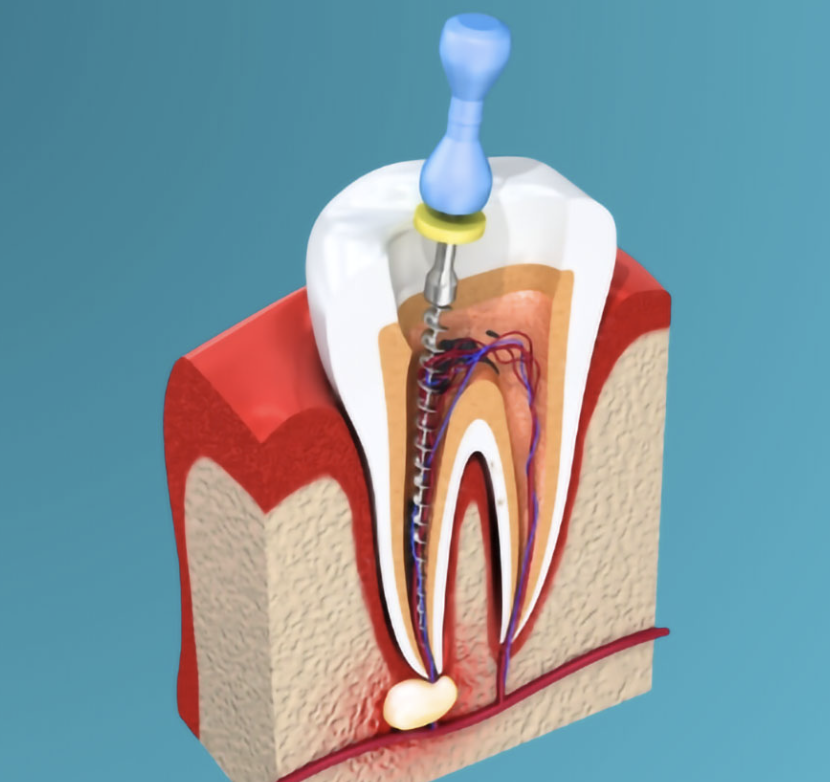 Root canal therapy