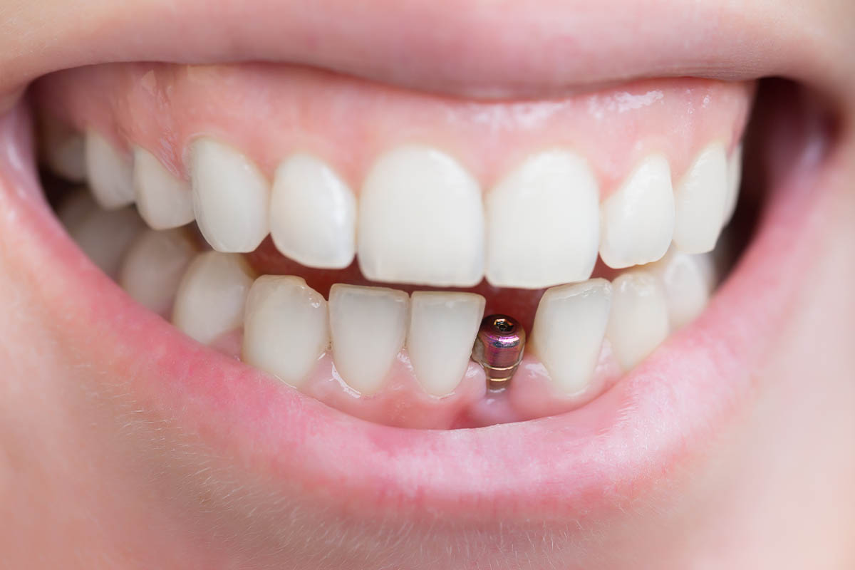 Single Implant in Wentworth point city