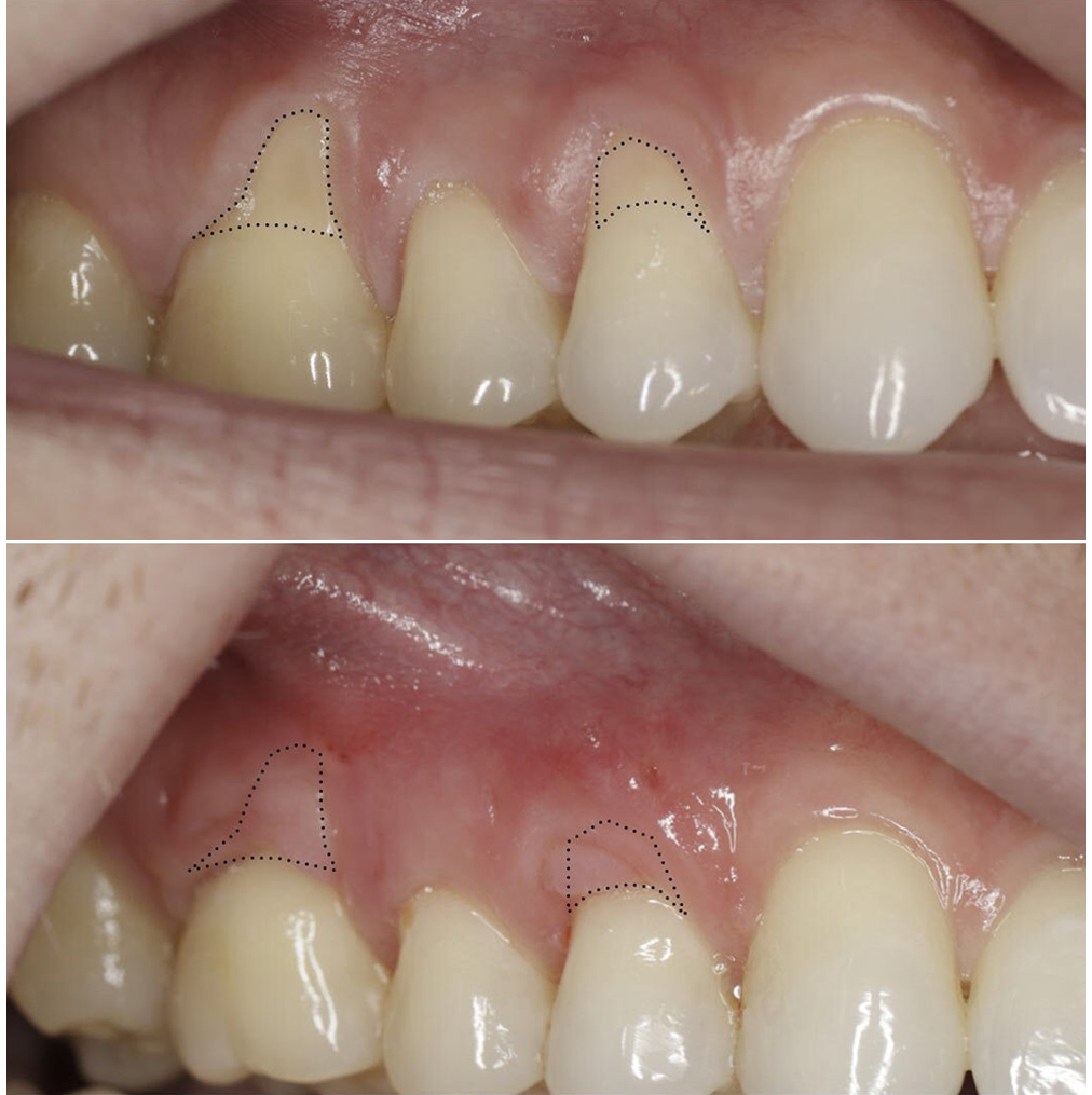 What is a Gum Graft?