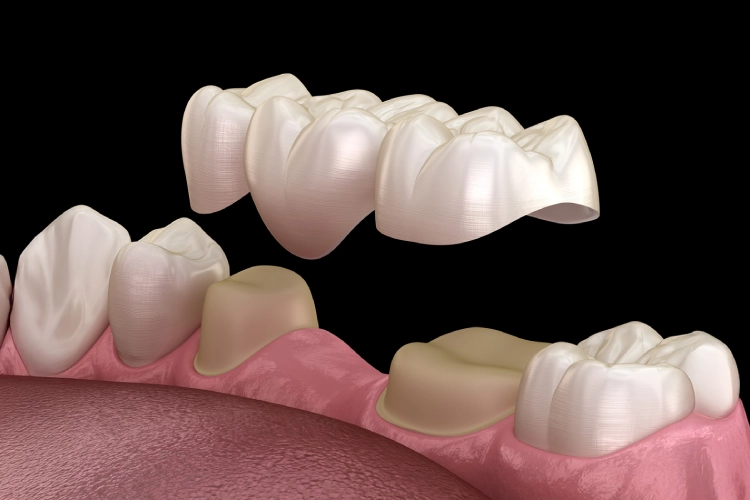 What is a Porcelain Bridge?