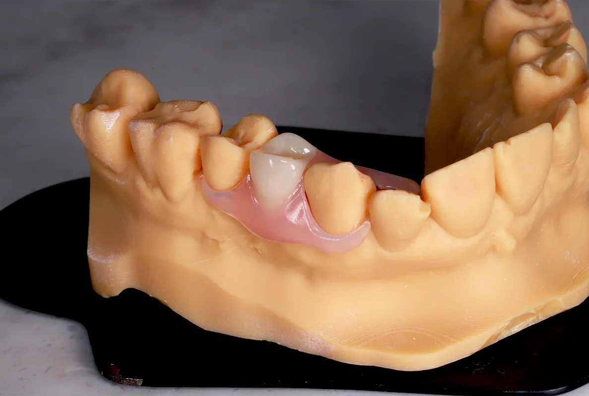 Flexible Dentures