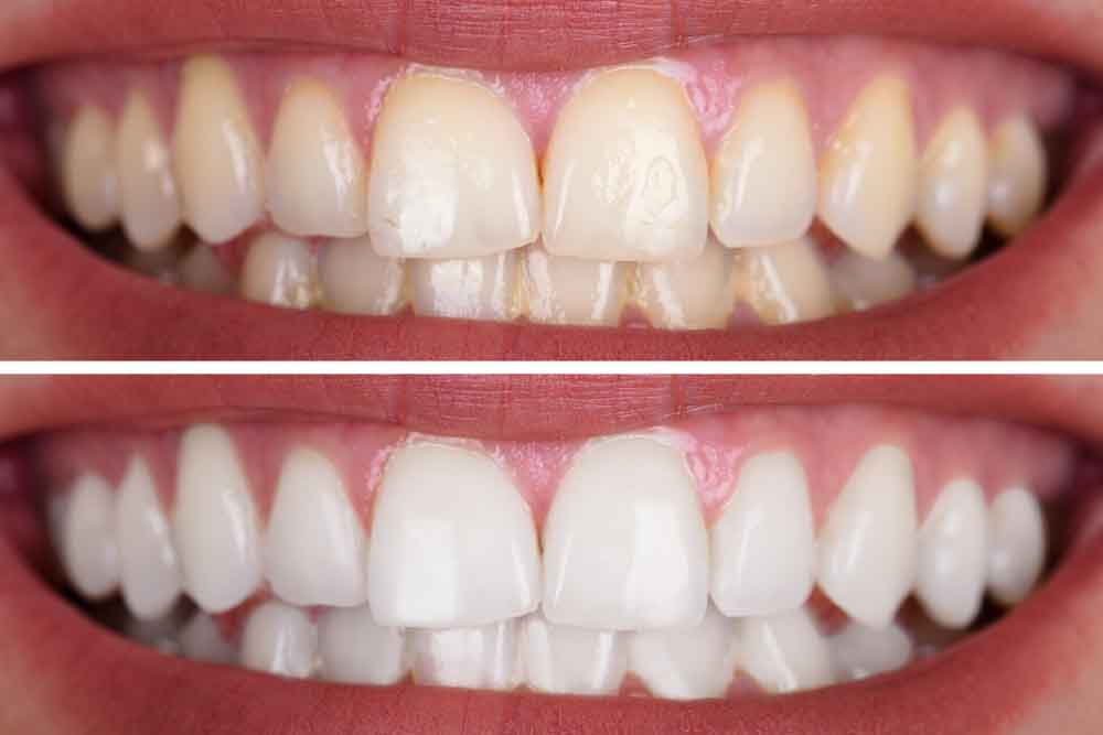 Teeth Whitening in Paramatta 