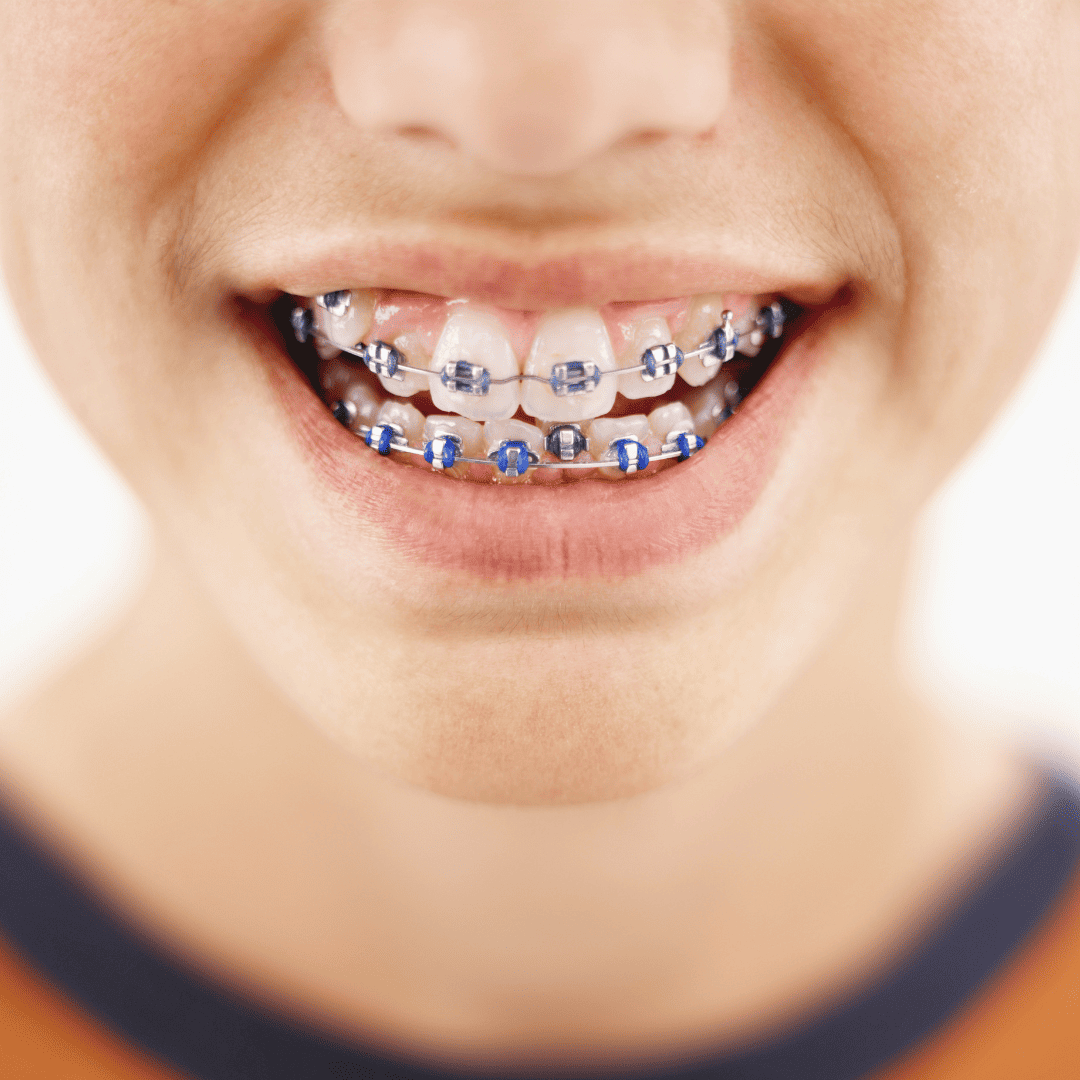 The Benefits of Braces in Rouse hill
