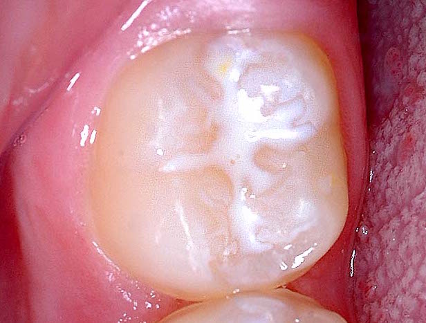 Fissure Sealants in Michinbury