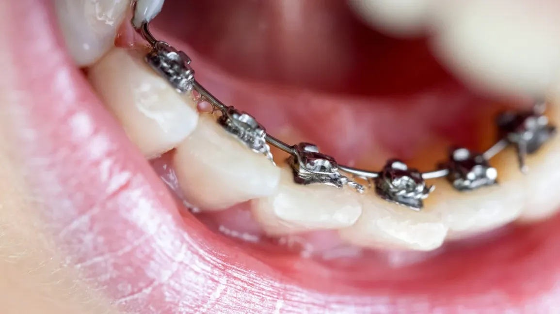 Lingual Braces in Wentworth