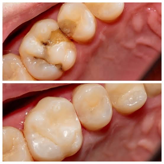 Why we Restore a Decayed Tooth in Chatswood