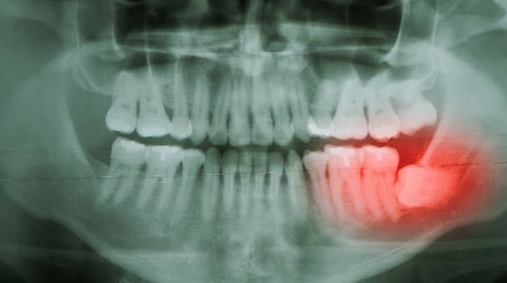 Wisdom tooth removal in Michinbury 