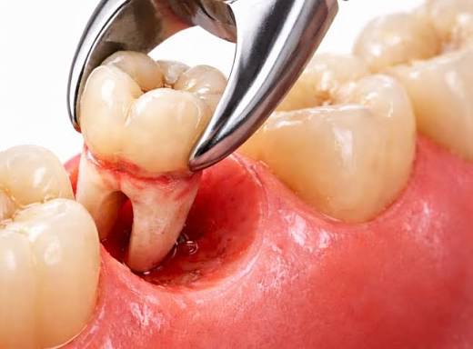Tooth Extraction in Paramatta