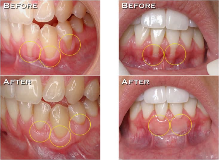 Gum graft in Berowra