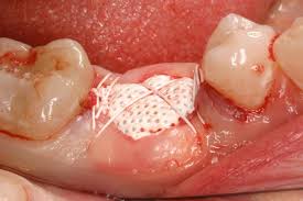 Socket Preservation in Sydney 