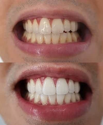 Why do our teeth become yellow? 