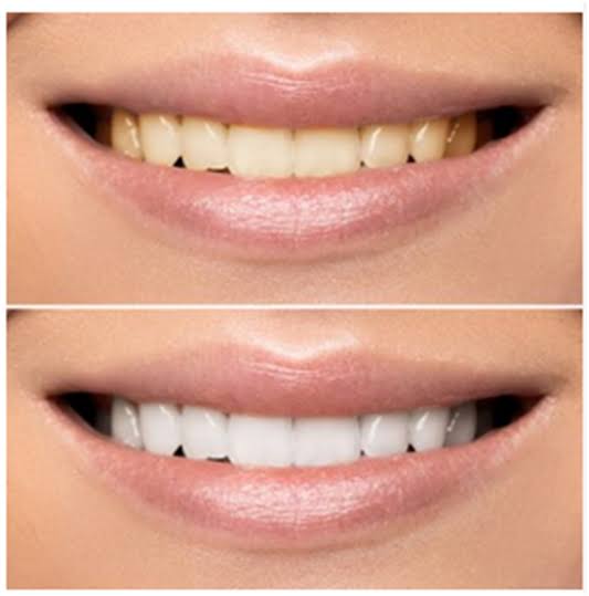 Dental Whitening in Chatswood 